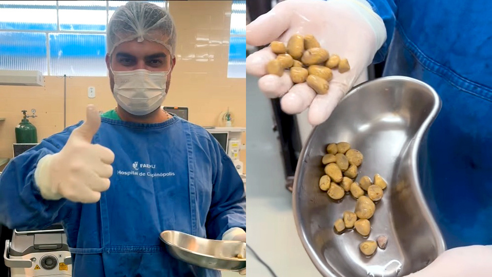 Y1.jpg 巴西泌尿科醫生 Dr. Thales Andrade 分享病例,為一位常喝汽水的男子開刀做手術,從膀胱取出多達 35 顆巨型腎結石,令人震驚。(圖:drthalesandrade@Instagram)