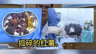 成都六旬翁將17釐米番薯塞入肛門-凌晨4點劇痛難忍就醫動手術