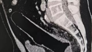 深圳中年漢-誤-將假陽具塞肛門-強忍三日拖成腸穿孔緊急手術取出