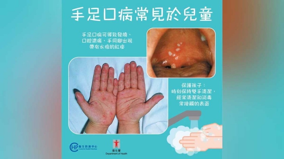 手足口病活躍度顯著上升-逾九成個案來自幼稚園或小學