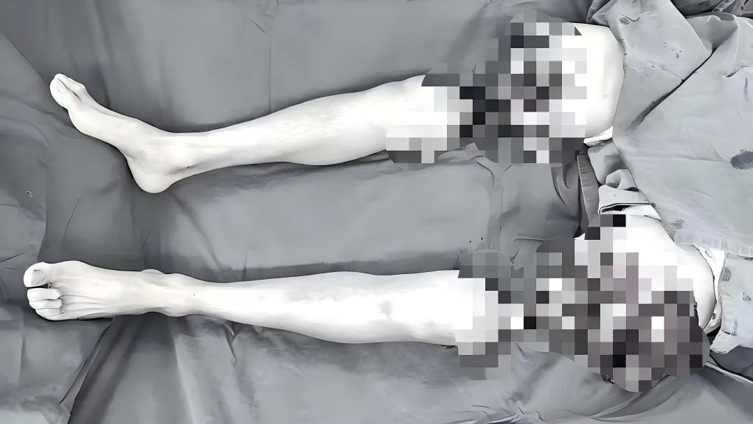 全球首宗-內地漢雙大腿完全離斷歷8小時手術接植-經康復現可站立行走