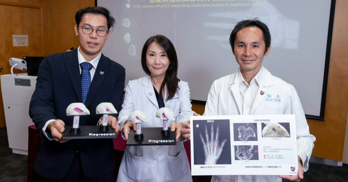 中大首創3D高解析度掃描-3分鐘驗類風濕關節炎助患者-早診早治