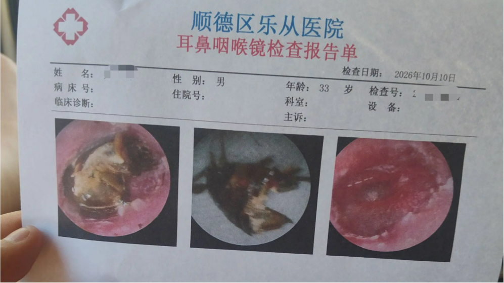 廣東一男子被蟑螂鑽進耳道-一周後就醫耳膜險穿孔聽力受損